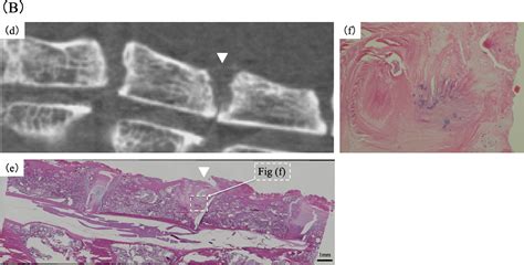 Improved Intervertebral Bone Union In Alif Rat Model With Porous