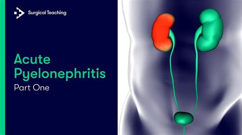 Pyelonephritis Causes Symptoms And Treatment