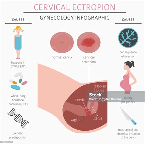 Cervical Ectropion Ginecological Medical Desease Infographic Stock Illustration - Download Image ...