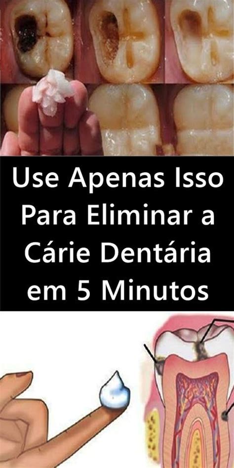 Use Apenas Isso Para Eliminar A Cárie Dentária Em Minutos Cárie