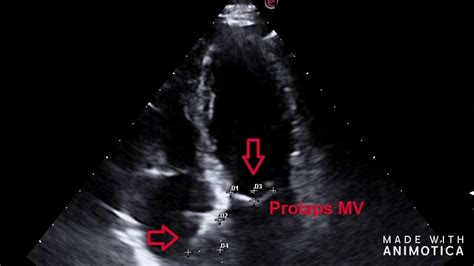 Mitral Valve Prolapse And Atrial Septal Aneurysm Prolaps Mv I