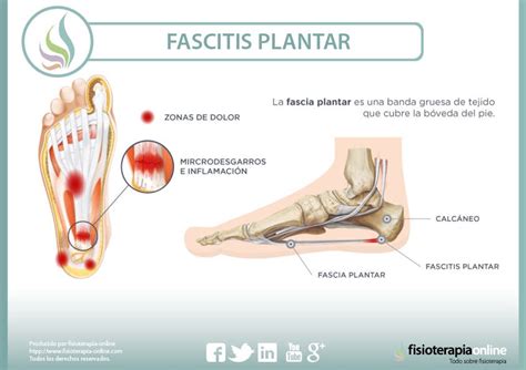 Fascitis Plantar Qu Es Cu Les Son Sus Causas Y C Mo Podemos Tratarla