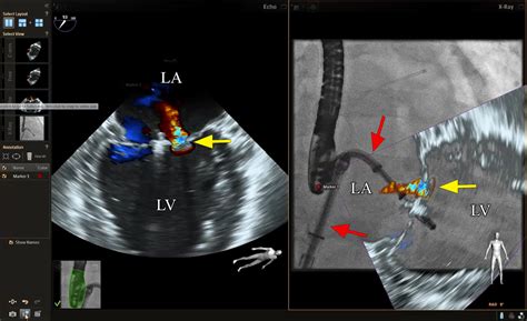 Fusion Imaging For Procedural Guidance Revista Española De Cardiología