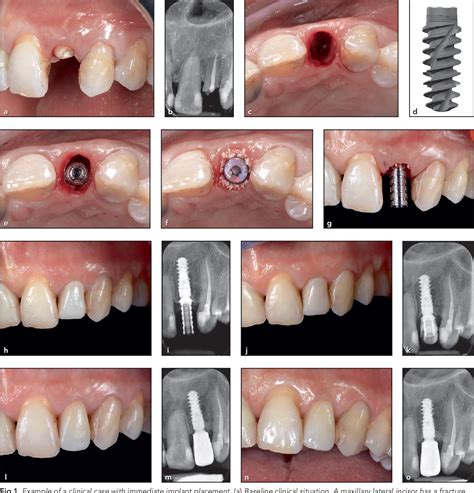 Figure 1 From Clinical And Radiologic Evaluation Of A Fully Tapered