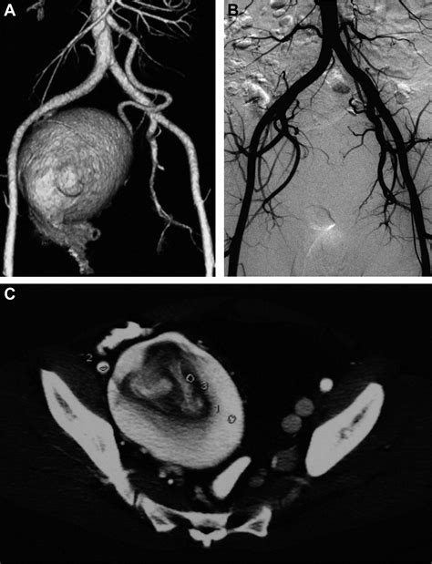 Surgical Management Of A Primary Retroperitoneal Venous Aneurysm