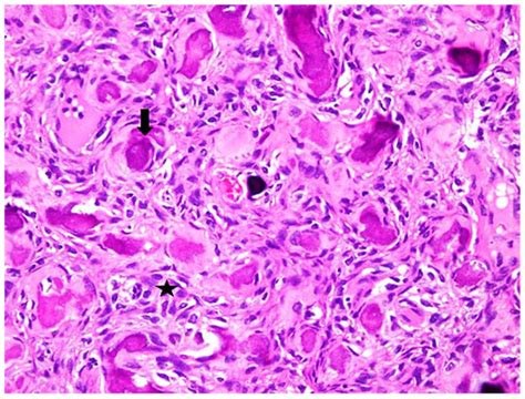 Juvenile Psammomatoid Ossifying Fibroma JPOF Of Proximal Radius A