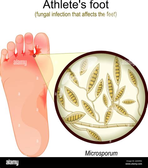 Athlete's foot. fungal infection that affects the feet. Close-up of ...