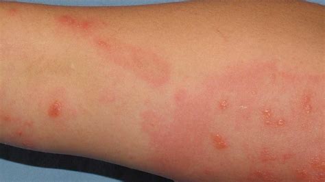 Itching Whats Causing Your Itchy Skin With Pictures