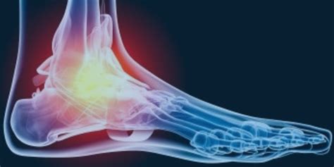 Foot Drop Symptoms And Treatments Legacy Spine And Neurological Specialists