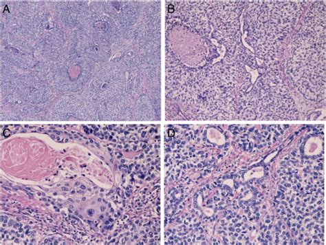 He Histologies Of Esophageal Basaloid Squamous Cell Carcinoma A Very