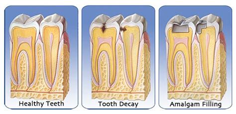 Filling cavity: Steps your Dentist takes to restore your ...