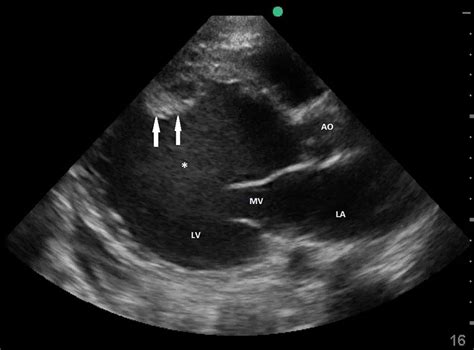 Transthoracic Echocardiography Showing Severely Dilated Lv With Download Scientific Diagram