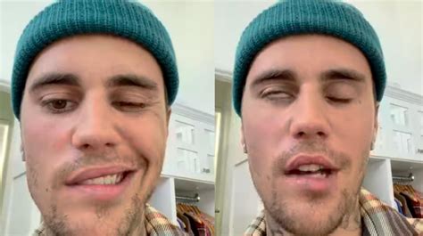 Síndrome de Ramsay Hunt Por qué Justin Bieber sufre de parálisis facial