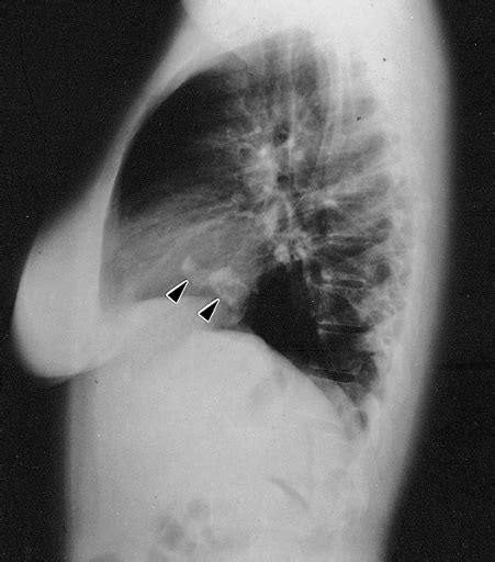 Labeled Lateral Chest X Ray