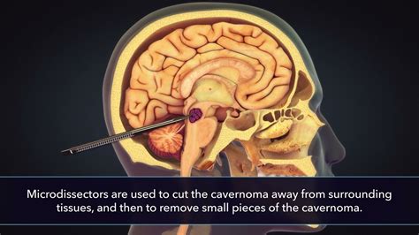 Medical Animation Of Brain Tumor Removal Youtube