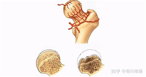 股骨头坏死的病因有哪些？股骨头坏死能自愈吗？ 知乎