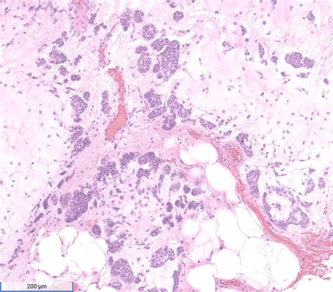 Week 787 Case 3 Johns Hopkins Surgical Pathology Unknown Conference