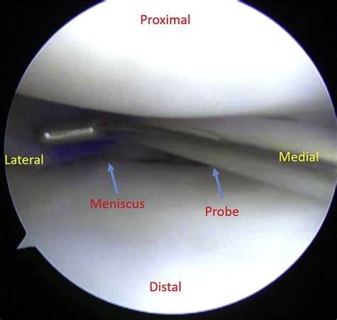 Meniscal Allograft Transplantation Made Simple Bridge And Slot