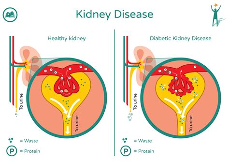 Diabetes and the Kidneys | Preventing Diabetes