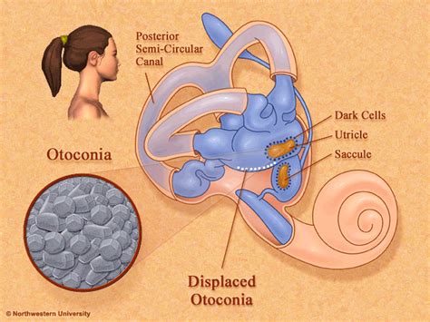 Benign Paroxysmal Positional Vertigo BPPV Marcaurel