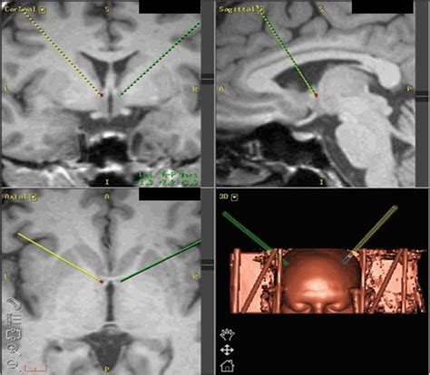 A Pilot Study Of Bed Nucleus Of The Stria Terminalis Deep Brain