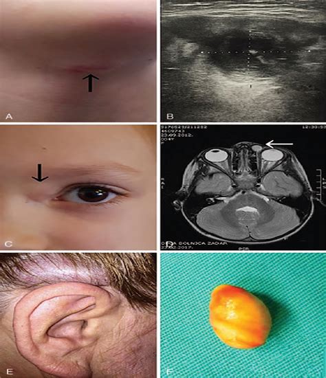 Epidermoid And Dermoid Cysts Of The Head And Neck Journal Of