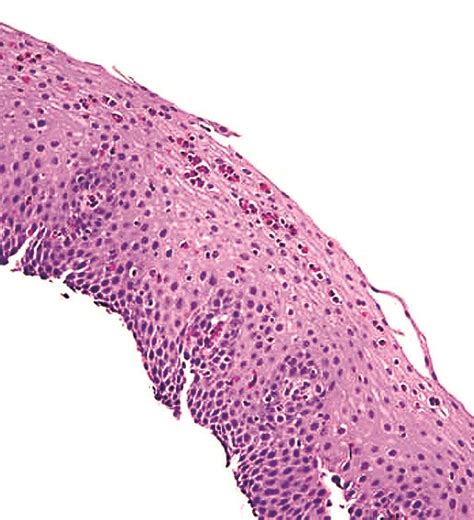 Pathology Outlines Eosinophilic Esophagitis