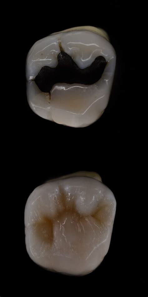 How Composite Resin Fillings Strengthen Teeth - Empire Dental