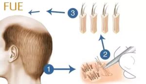 Hair implant surgery - Hair transplantation basics