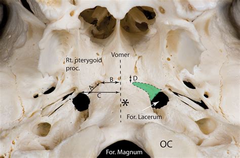 Artery Of Pterygoid Canal