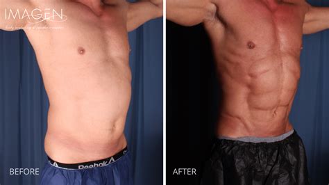 Men S Liposuction Omaha Liposuction By Imagen