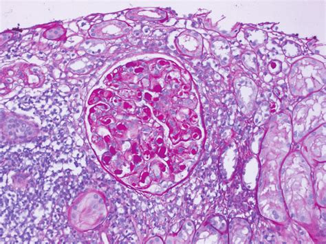 Renal Biopsy PAS With Diastase 200x Magnification Enlarged Glomeruli