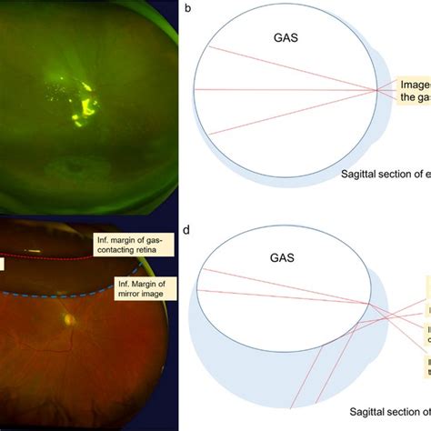 Preoperative OCT Of Traumatic Macular Hole With Silicone Oil Tamponade