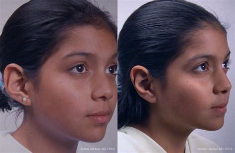 Otoplasty And Earlobe Repair Before After Gallery Patient 25