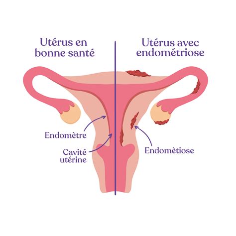 L endométriose qu est ce que c est Tidoo