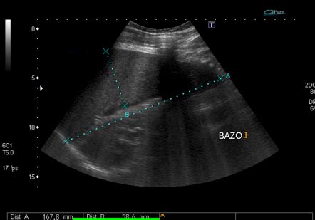 Splenic infarction | Radiology Case | Radiopaedia.org