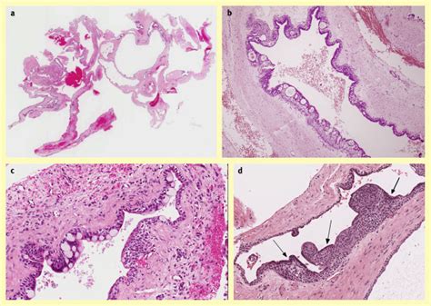 Odontogenic Cysts Diagnostic Histopathology