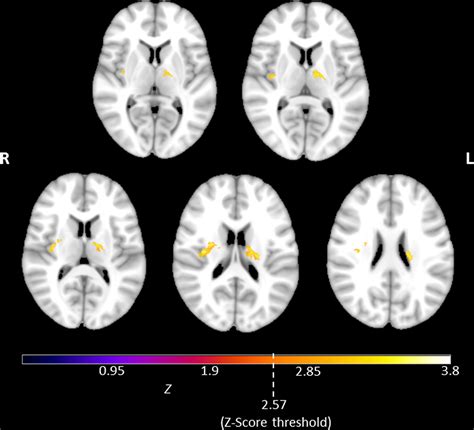 Association Of Lesion Pattern And Dysphagia In Acute Intracerebral