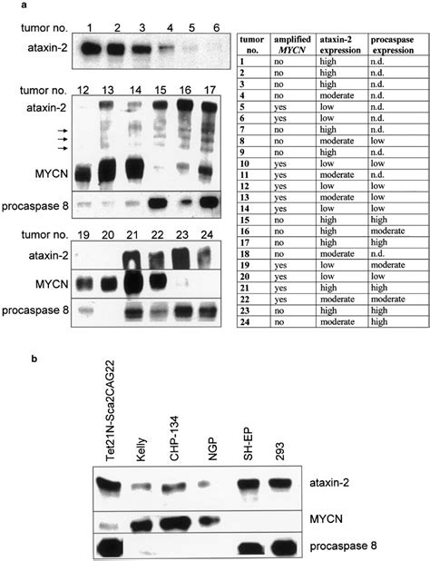 Expression Of Ataxin Protein In Human Neuroblastoma Tumors And Cell