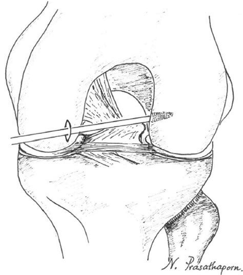 A Double Loaded Suture Anchor Is Inserted Into The Femoral Footprint Of