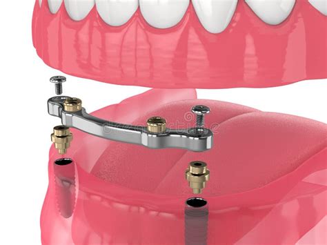 3d Render of Bar Retained Removable Overdenture Installation Supported ...