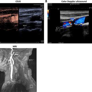 Doppler Ultrasound Contrast Enhanced Ultrasonography Ceus And