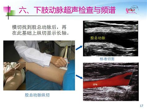 下肢血管的超声检查及正常声像图