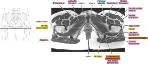 MRI of the female pelvis | Radiology Key