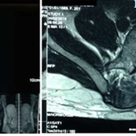 A: T1 Sagittal MRI Image of Lumbar Spine and B: T1 Axial MRI Image with ...