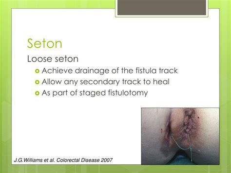 PPT The Best Surgical Treatment For Fistula In Ano PowerPoint