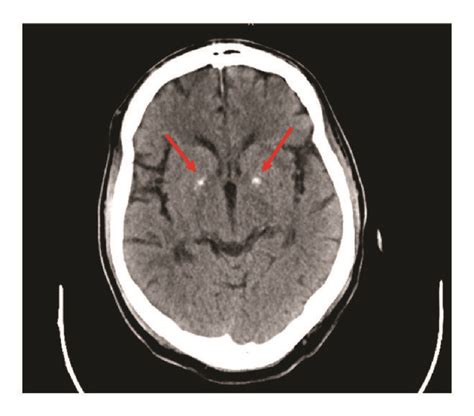 Basal Ganglia CT Scan