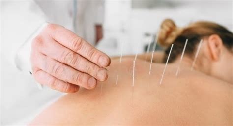 When Do Chiropractors Use Acupuncture Acupuncture Kitchener