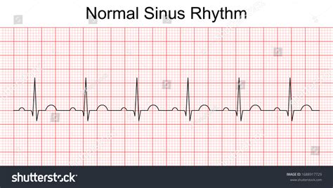 1,018 Ekg sinus rhythm Images, Stock Photos & Vectors | Shutterstock