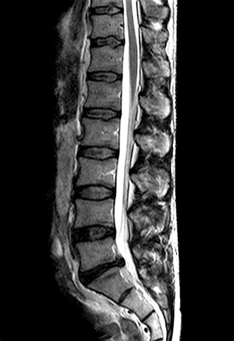 Herniated disc MRI | AllSpine